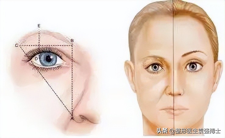 三角眼眼皮松弛怎么做好看,45岁上眼皮松弛下垂出现三角眼