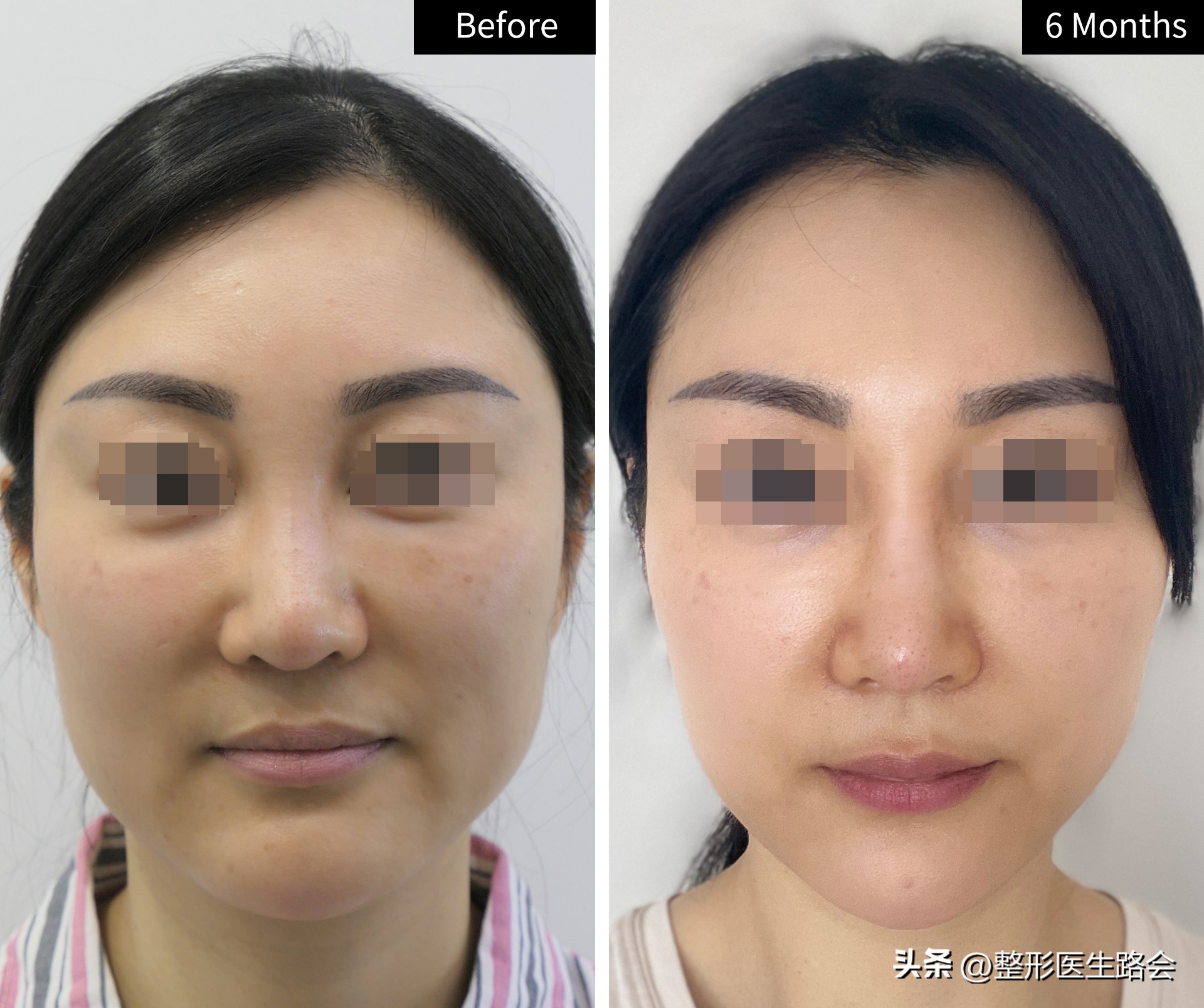 做鼻基底填充消除法令纹有风险吗,鼻基底填充能消除法令纹吗