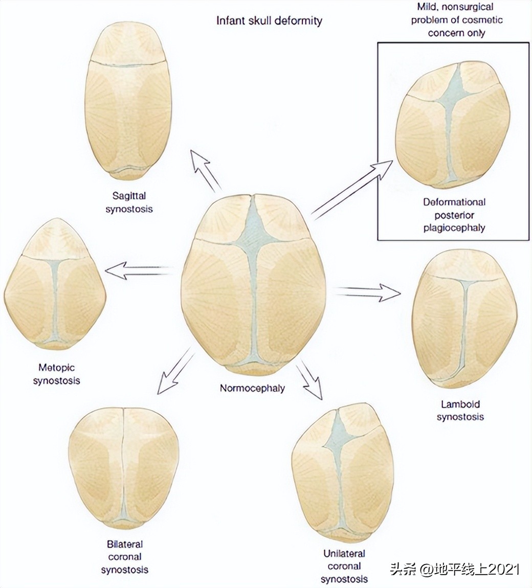 想让孩子有一个漂亮的头型，如何预防和治疗偏头与扁头？