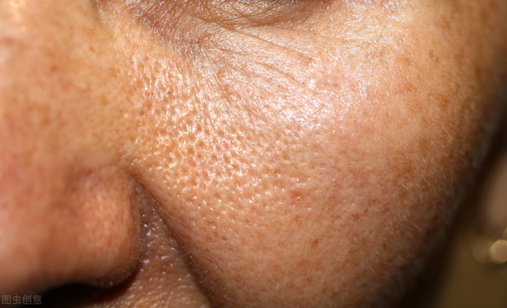解决毛孔粗大最有效医美的方法,瑕疵肌毛孔粗大怎么改善