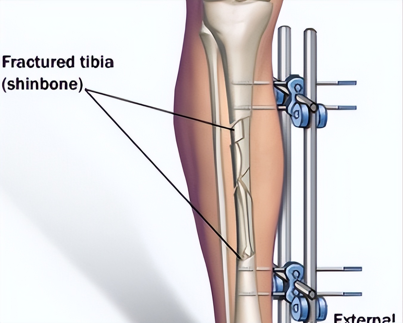 德国断骨增高20厘米,德国最新断骨增高术
