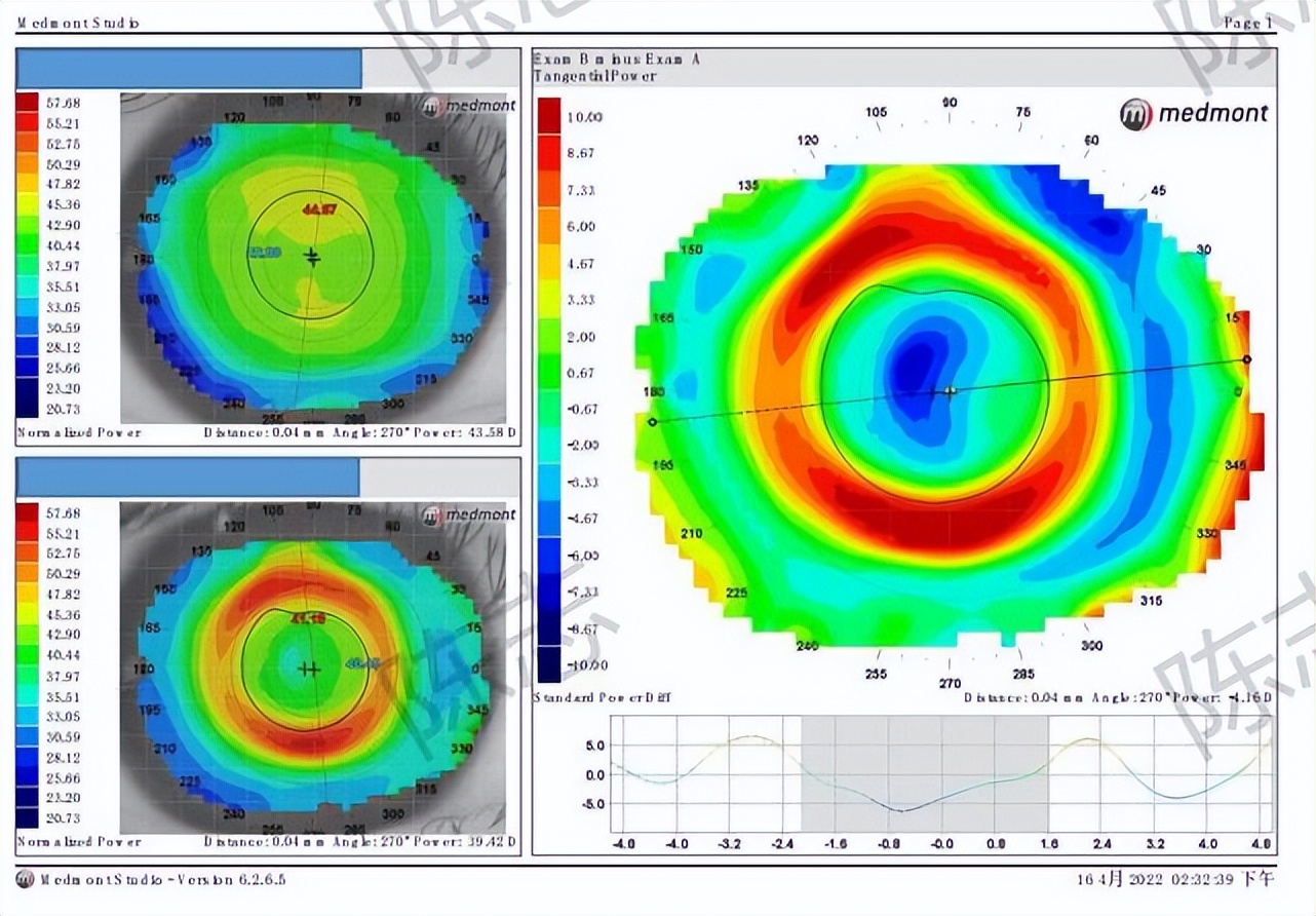 角膜接触镜验配案例图解,戴角膜塑形镜反复出现点染的原因