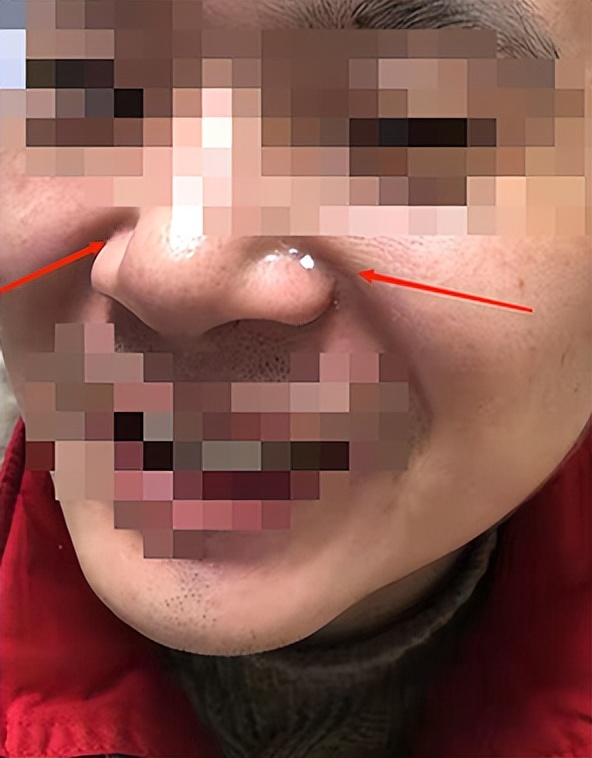 脸上反反复复红肿流黄水怎么回事,一夜之间脸上突然红肿流黄水