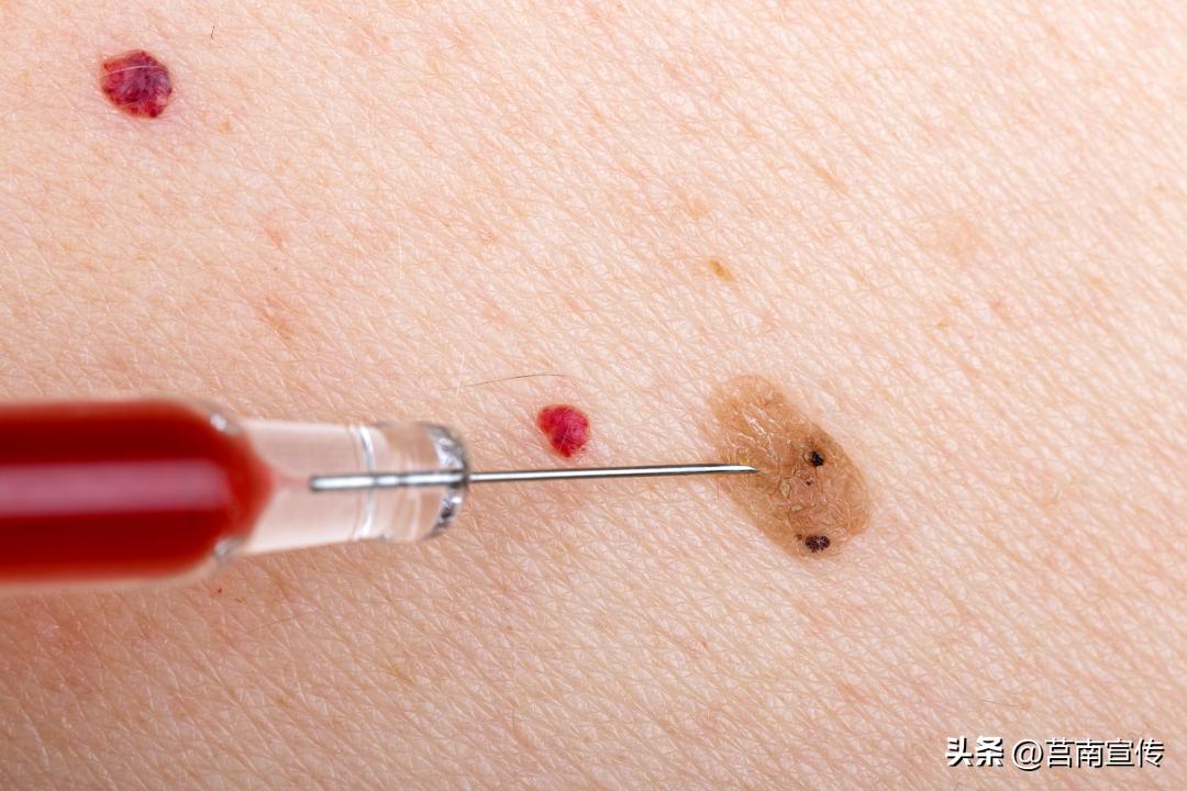 身上长这几个小红点是癌症,身上长了红点看什么科