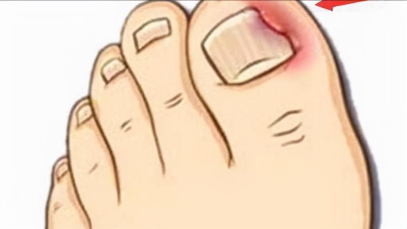 指甲往肉里长怎么办,指甲老往肉里钻