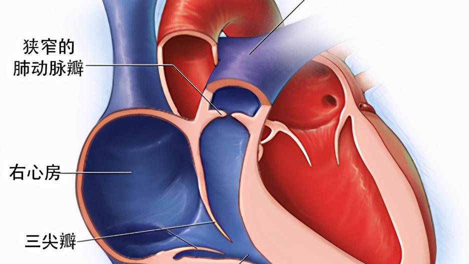 儿童肺动脉轻度狭窄怎么回事,儿童肺动脉闭塞的治疗方法