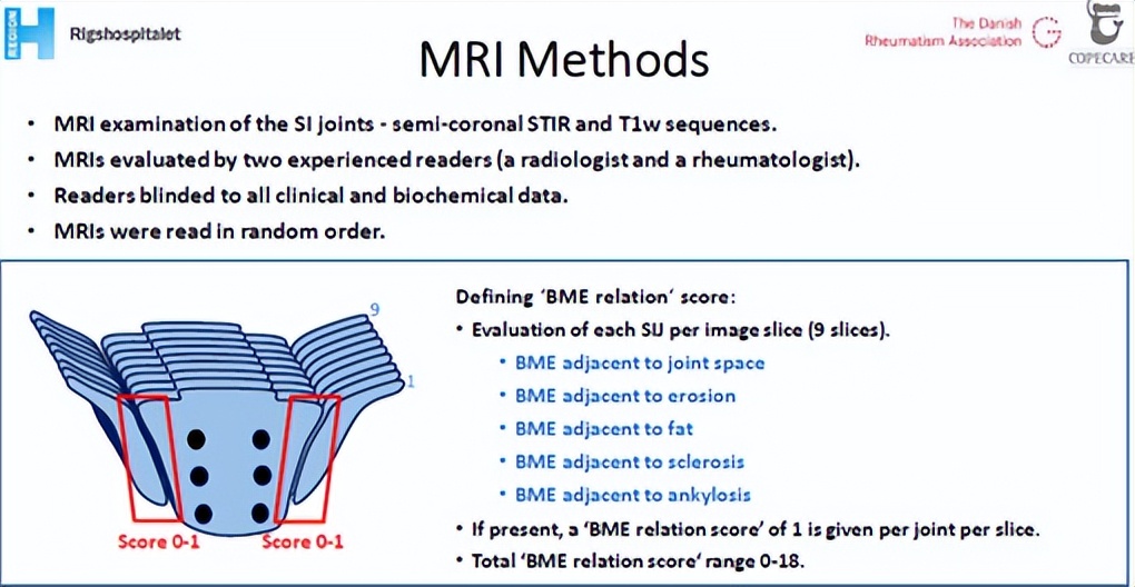 骶髂关节骨髓水肿最好的治疗方案,骶髂关节炎是脊柱关节病的一种吗