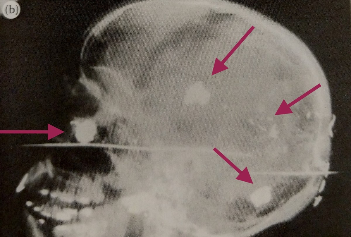 男子喝核辐射水下巴糜烂惨不忍睹,美国男子三年喝下1400瓶核辐射水