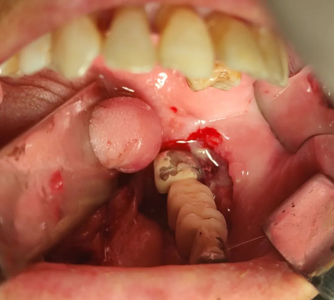 上牙龈红肿不痛且有点溃烂是癌吗,牙龈溃烂是癌症的早期信号么