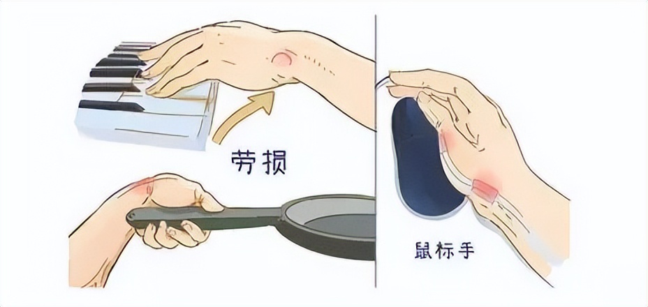 腱鞘炎小拇手指疼怎么治,由于劳累导致拇指腱鞘炎怎么办