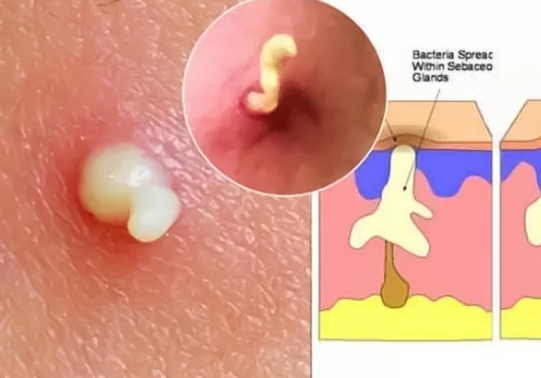 清滋颜：粉刺鼓包疼痛难受挤不住来怎么办？这里有高效处理方法