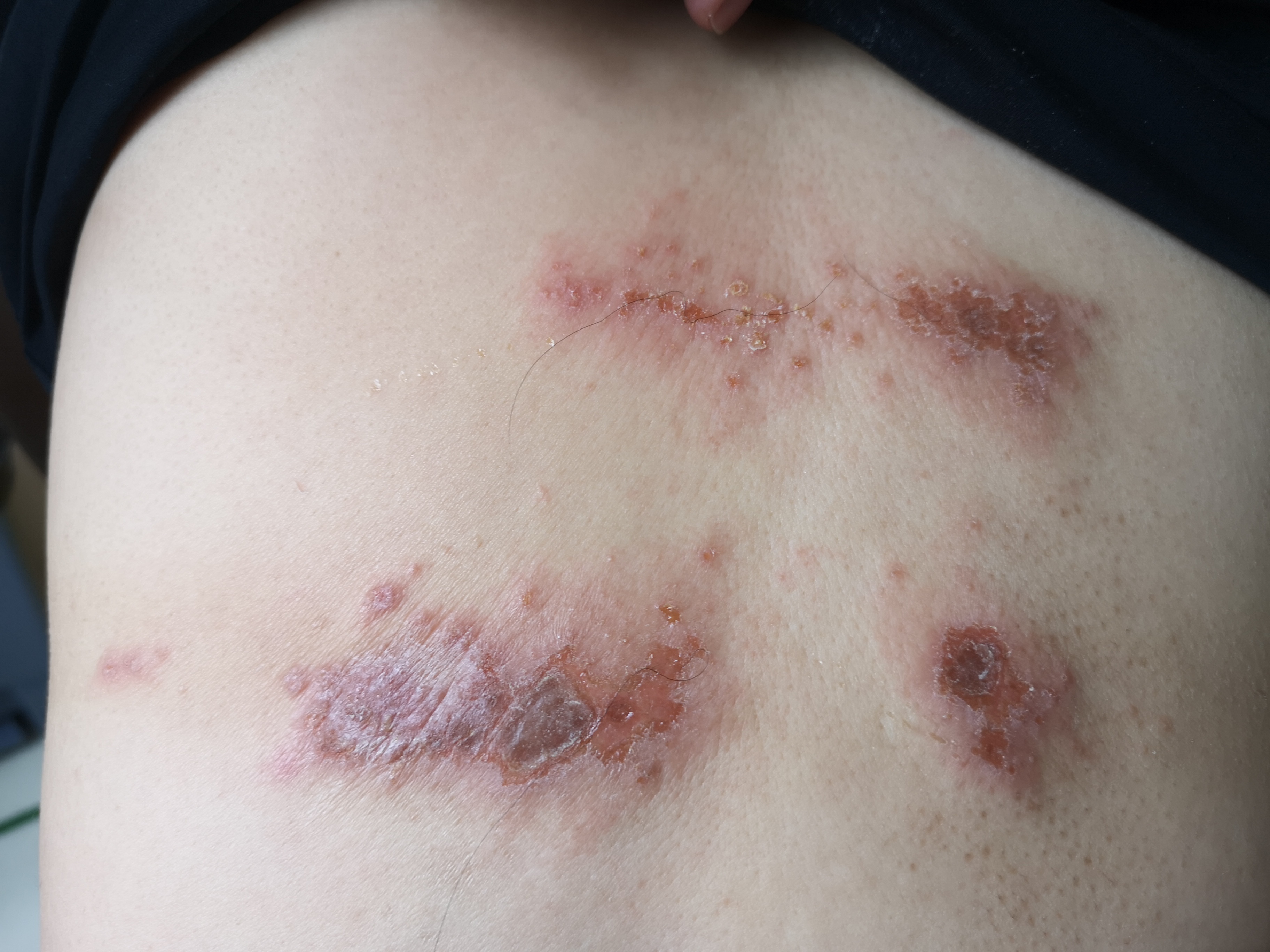 对镍过敏是怎么回事,镍过敏的人多不多