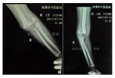 肱骨骨折取钢板怎样恢复,肱骨近端骨折切开复位内固定术