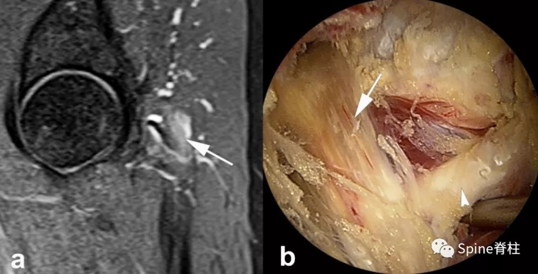 针灸治疗梨状肌综合征,一文了解贲门失弛缓症