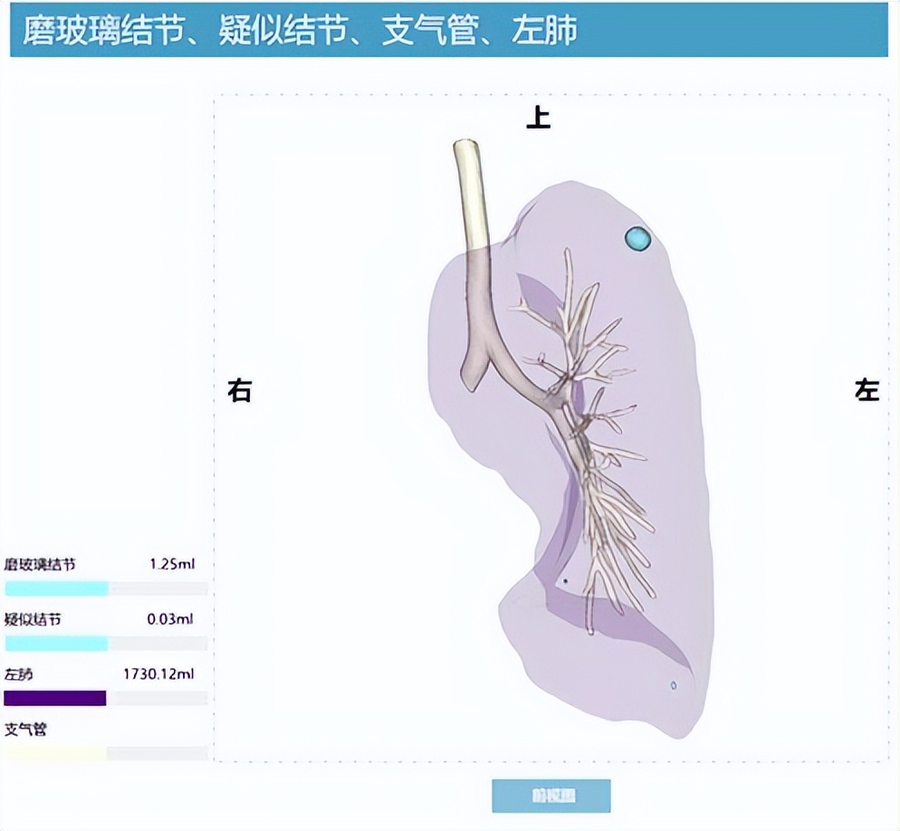 肺结节2x2mm实性结节是癌吗,4毫米结节是肺结节是癌前病变吗