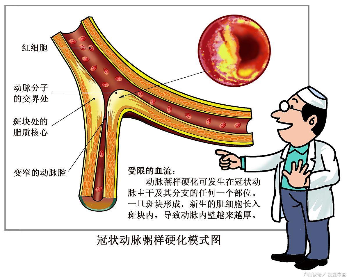 改善动脉粥样硬化的中药,如何通过食疗调理动脉粥样硬化