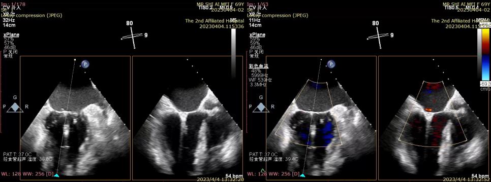 “小心尖、大作为”哈医大二院心外科微创治疗瓣膜疾病造福患者