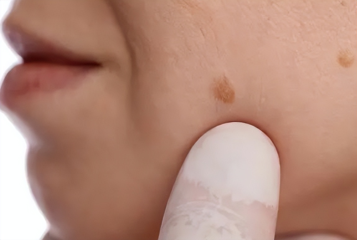 医生发现大黑痣的秘密,这些地方长黑痣要注意