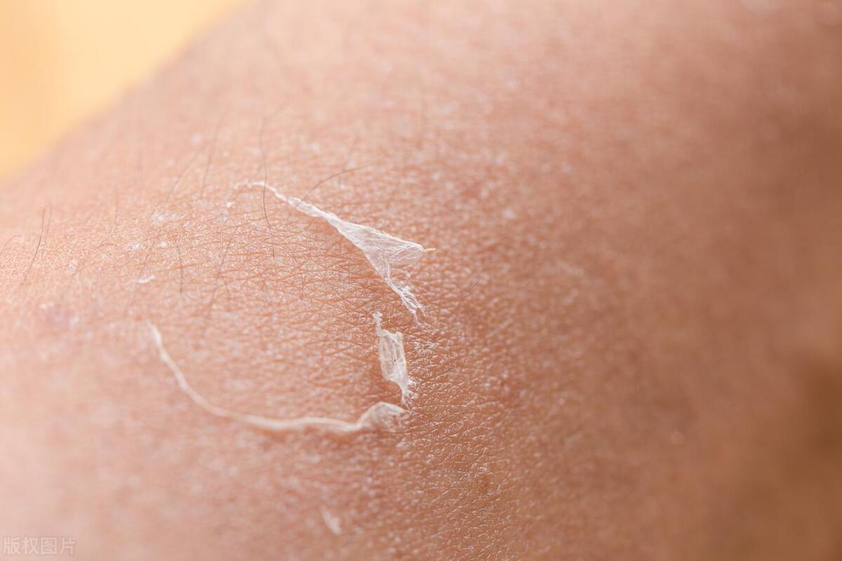 拔火罐的瘀血是身体内的毒素吗,拔火罐拔出的淤血是体内的毒素吗