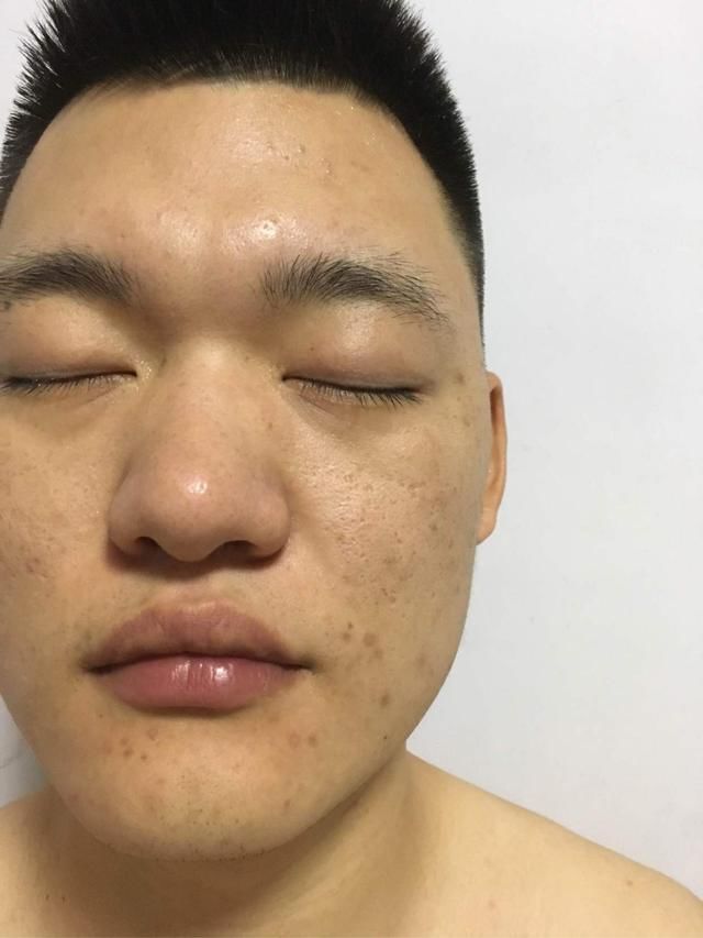 清洁面膜可以去黑头粉刺闭口吗,清洁面膜可以去除黑头吗