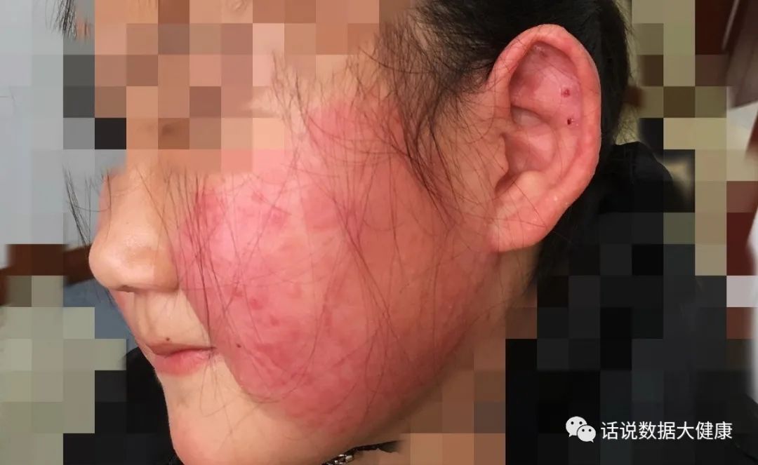 痔疮最好的治愈方法是什么,疮的治法