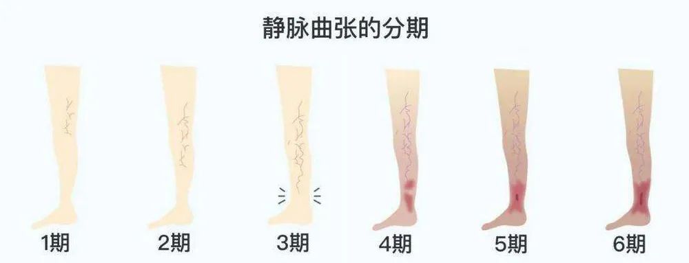 跷二郎腿静脉曲张怎么治,静脉曲张跷二郎腿有好处吗