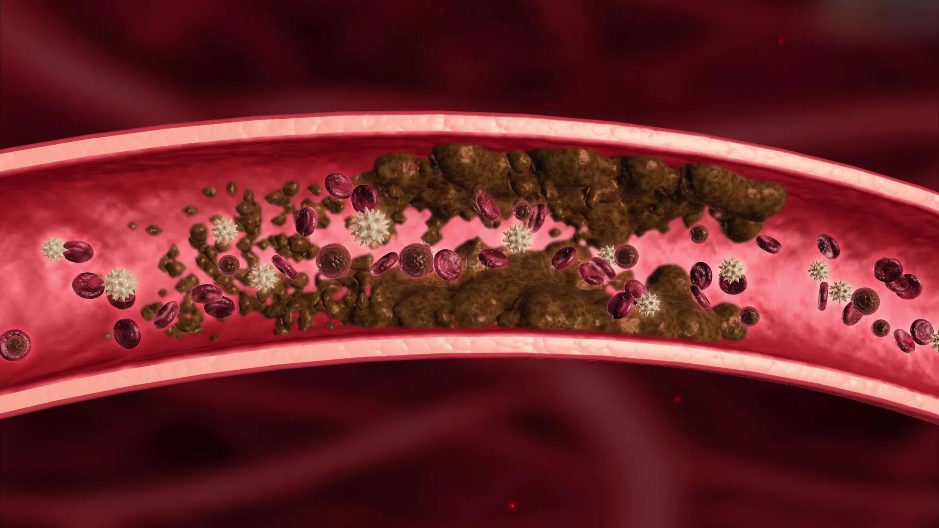 脑卒中的最新特效药,治疗脑卒中有效的中药