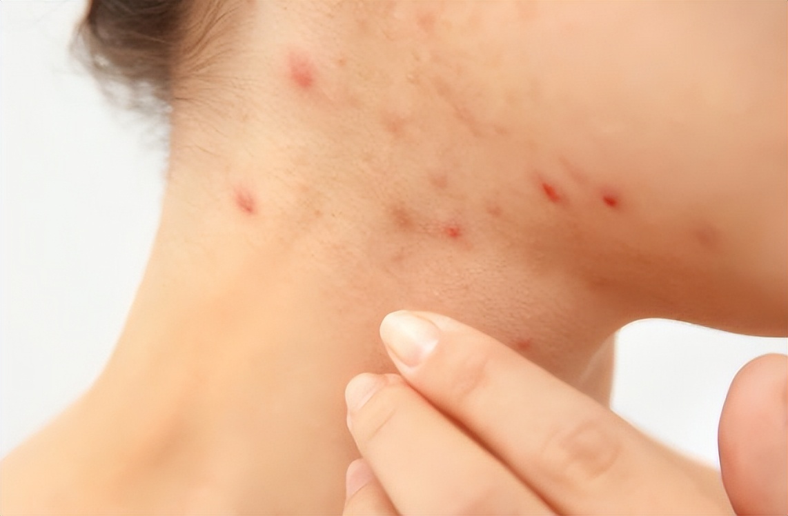 脖子上长了小肉粒可以自然消掉吗,脖子和腋下小肉粒是什么疣