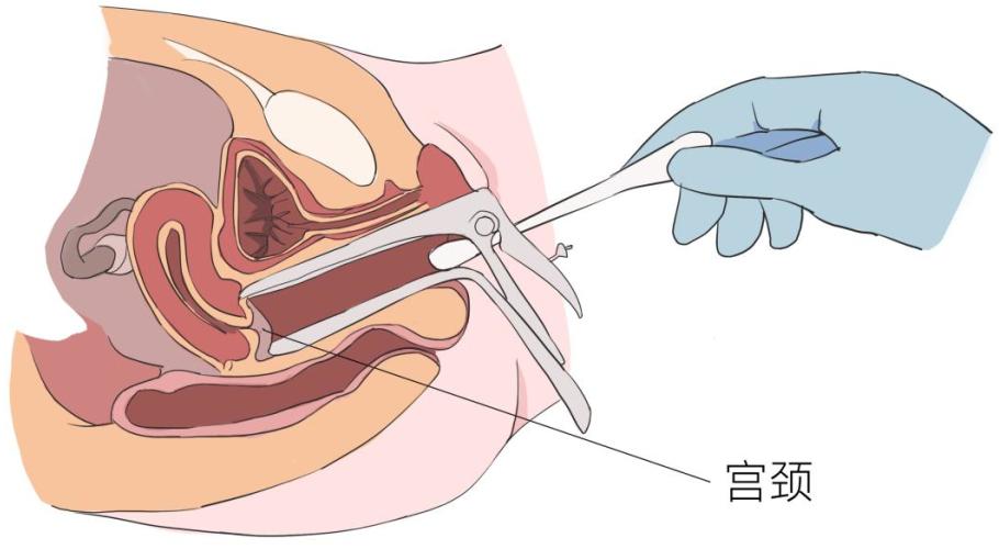 「疾病科普」宫腔粘连的治疗
