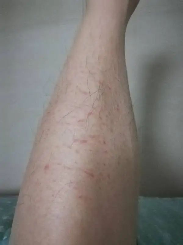 皮肤洗不干净老是脱皮,不洗澡身上晒得脱皮了怎么办