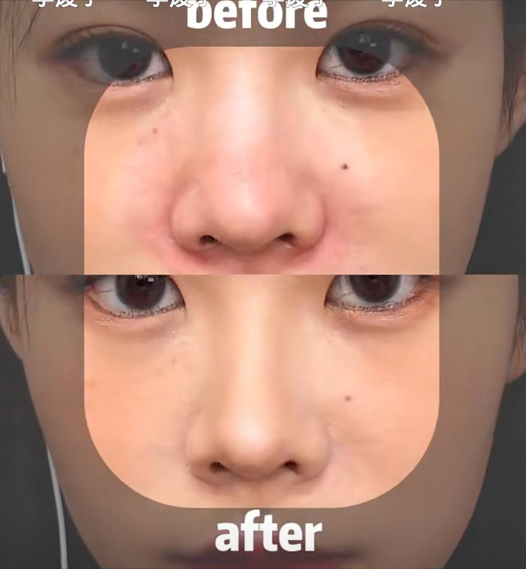 塌鼻子变美思路看这里,塌鼻梁怎么变漂亮