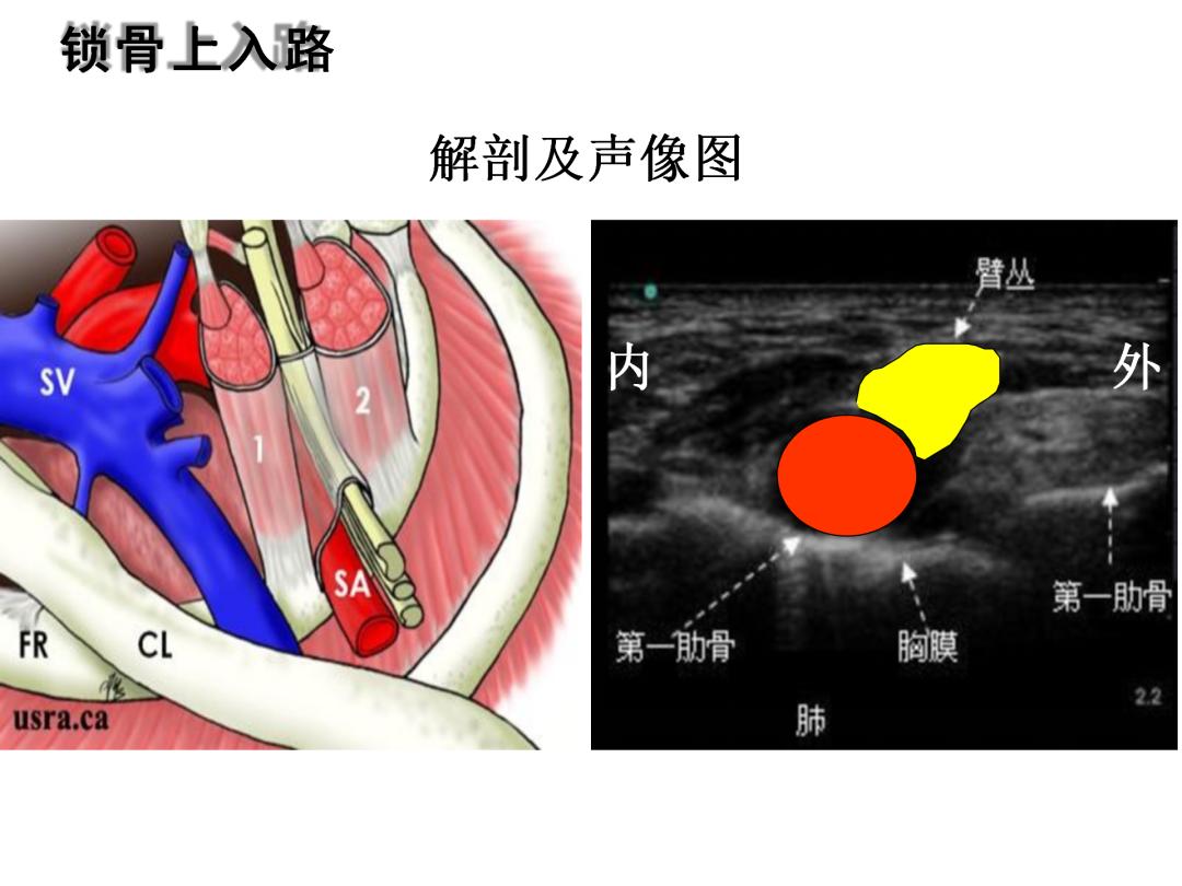 超声引导下臂丛神经阻滞,PPT课件