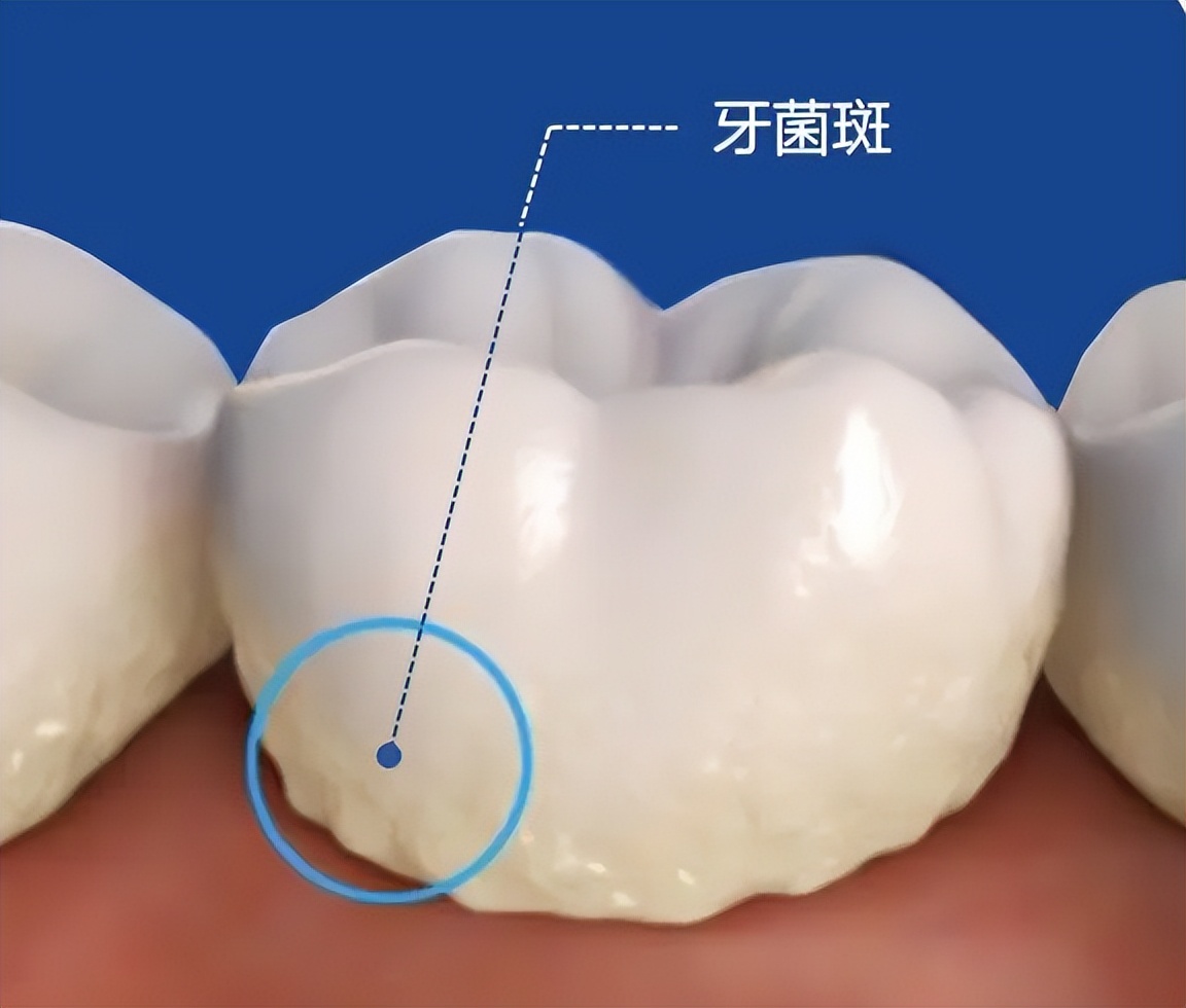 牙膏牙粉牙贴真的有用吗,美白牙贴牙膏