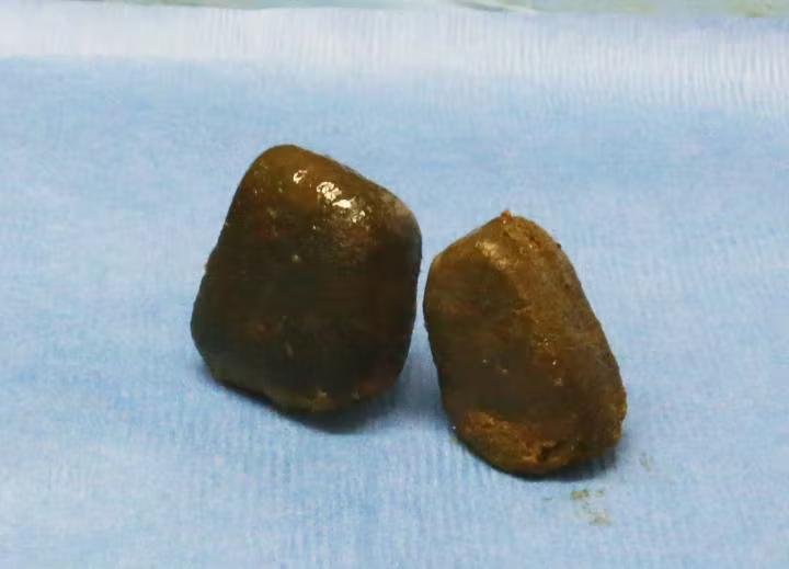 拉一次大便有两斤吗,拉一次屎能排多少毒