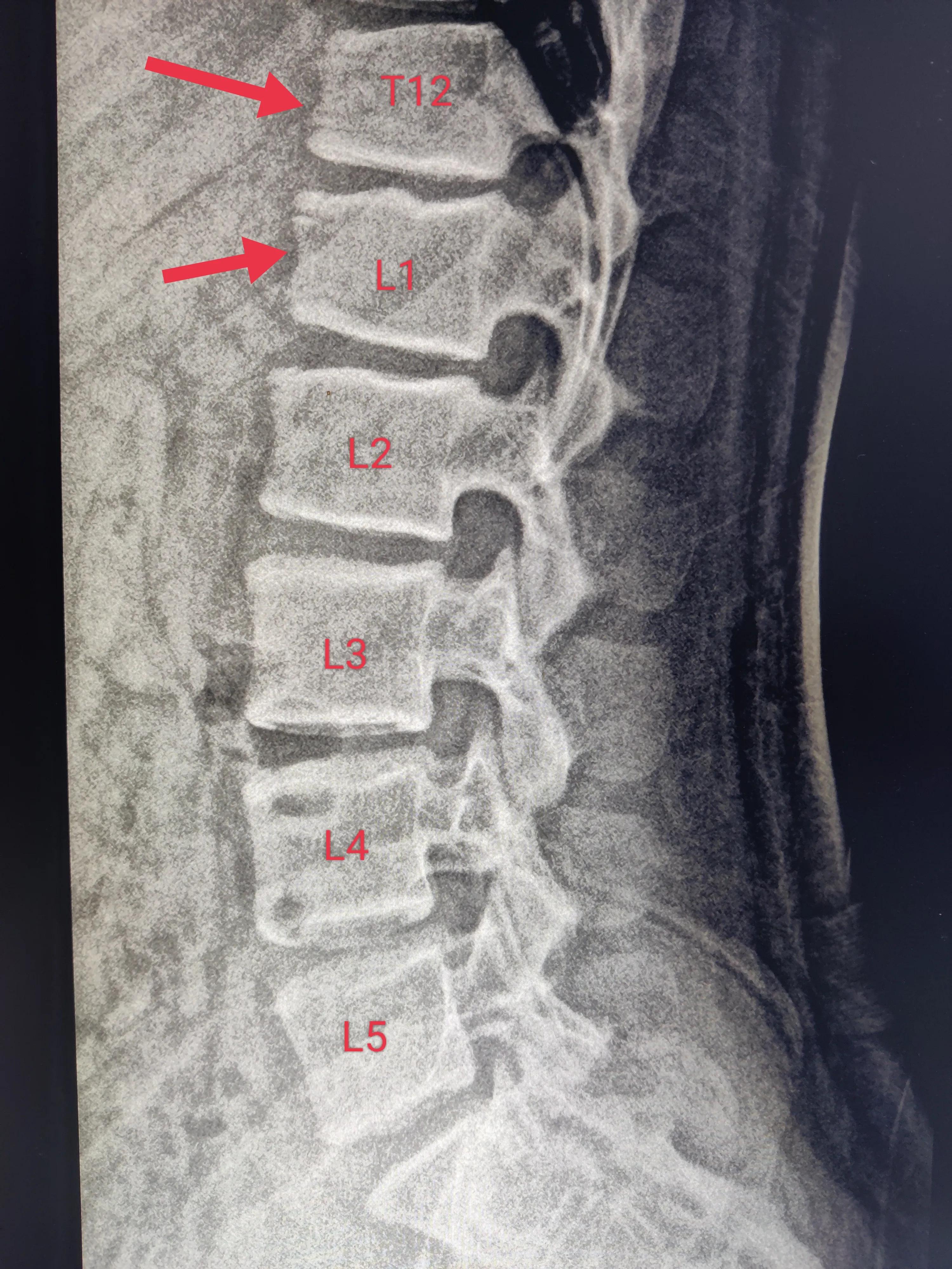 小朋友腰疼驼背怎么办,孩子弓腰驼背找哪科医生看
