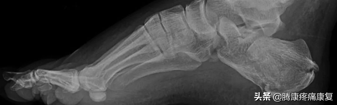 功能性高足弓的练习方式,用什么方法舒缓足弓疼痛