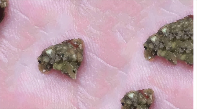 肾结石是什么病，治疗不及时会发生什么？术后护理需要注意些什么