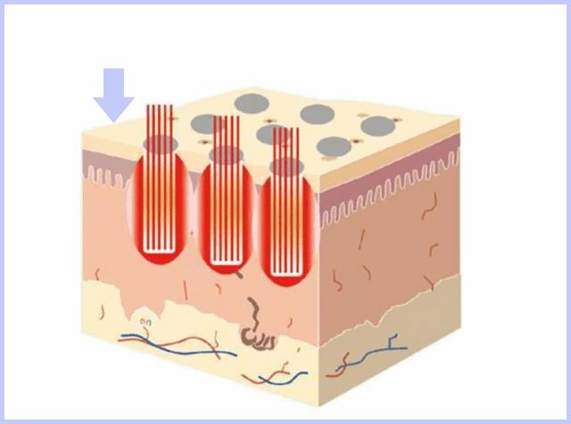 祛痘的十大误区你中招了吗,祛痘也有误区痘痘肌教你护理