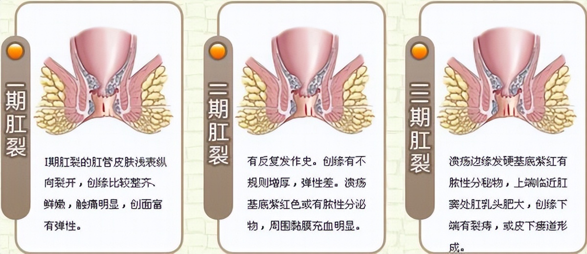 女性易患肛裂的原因是什么,导致肛裂的各种原因