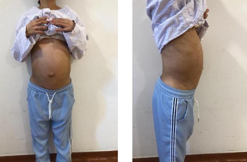 子宫肌瘤罕见,罕见子宫肌瘤半年疯长到20公分