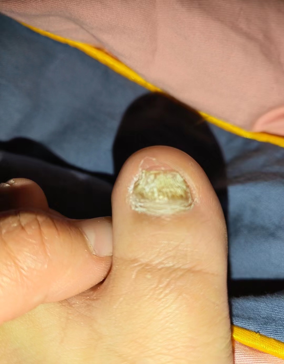 有不花钱治灰指甲的土办法吗,灰指甲不用怕一个简单杀菌小妙招