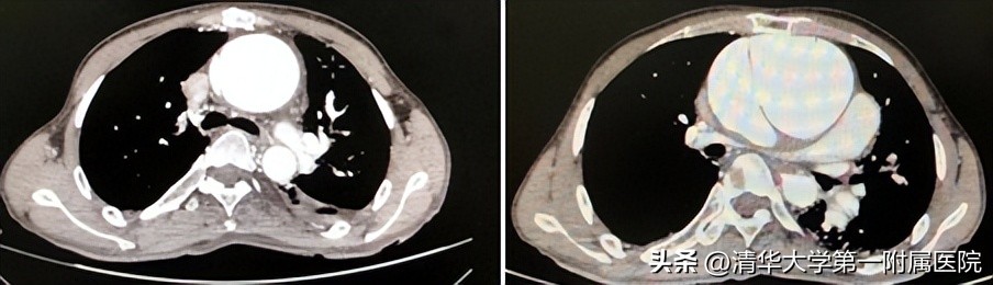 主动脉瘤并发生主动脉夹层,升主动脉至腹主动脉夹层动脉瘤