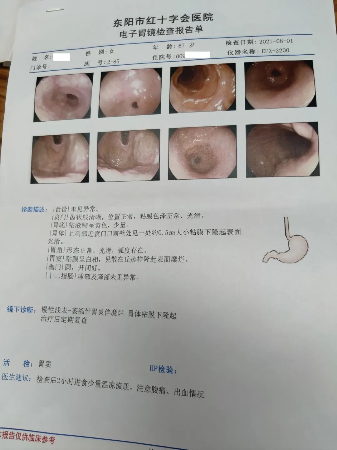 肠化调理中医,中医治疗中度肠化逆转案例