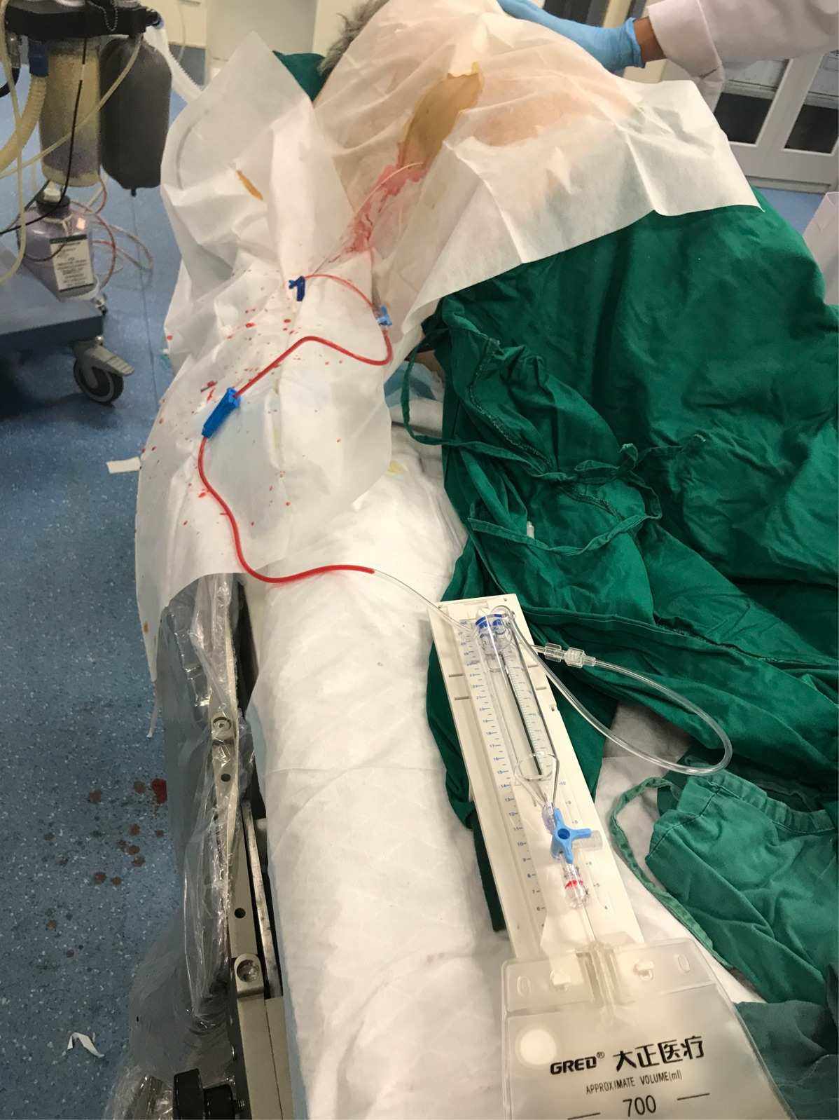 动脉瘤蛛网膜下腔出血术后并发症,动脉瘤导致蛛网膜下腔出血严重吗