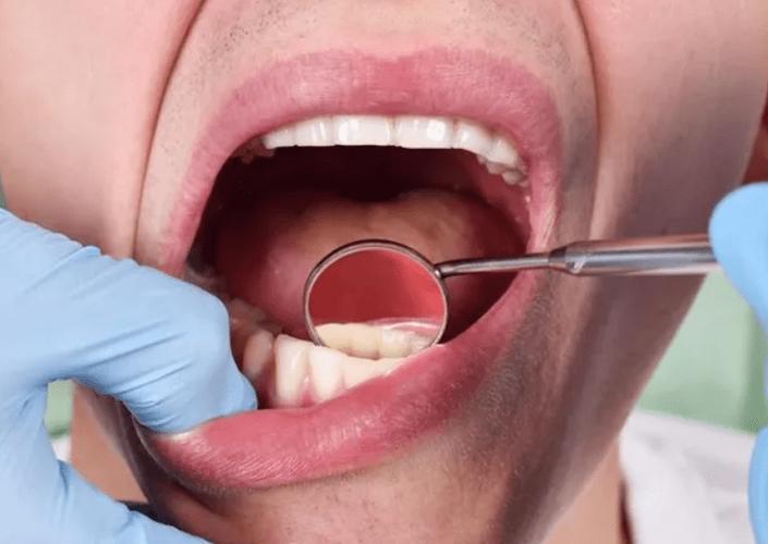 槟榔：6000万中国人的“定时*弹炸**”，有人心存侥幸，有人浑然不知