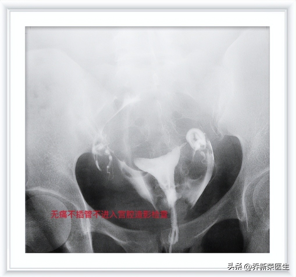 ​输卵管堵塞的症状与宫外孕的警示：理解生殖健康的两大关键