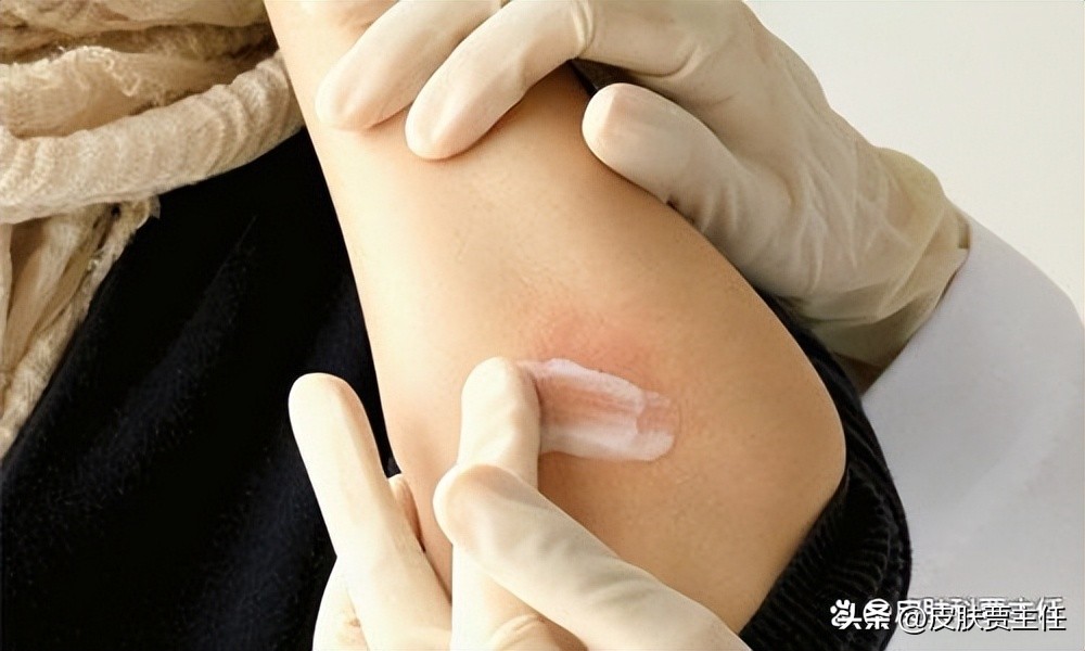 读完这篇文章，让你知道银屑病到底是什么，如何科学地来治疗