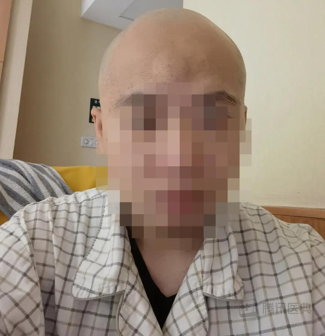 开颅手术后被掀开的头皮多久恢复,开颅手术掀开头皮头皮怎么恢复的