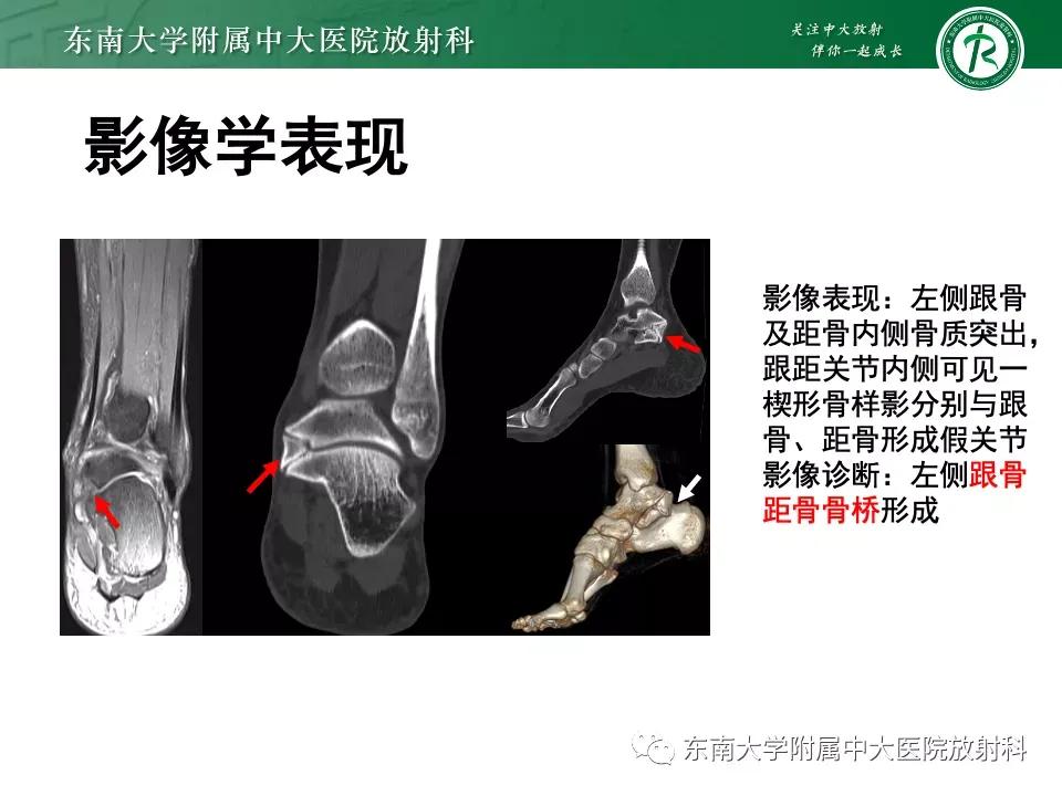 好文分享-《肌骨系统疾病——副舟骨综合征》