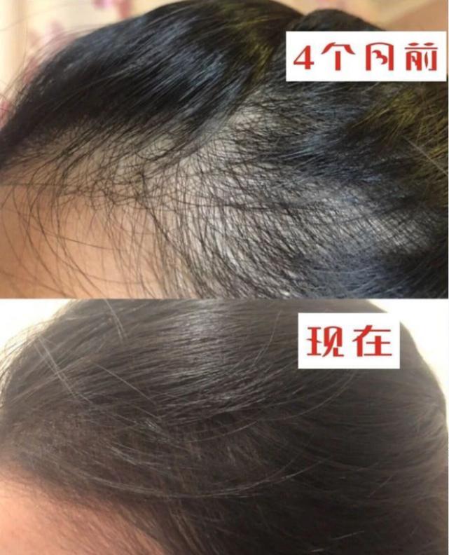 这些生发误区你还在做吗,这些防脱发产品你值得拥有